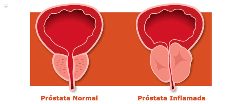 Prostatitis 1 Prostatitis