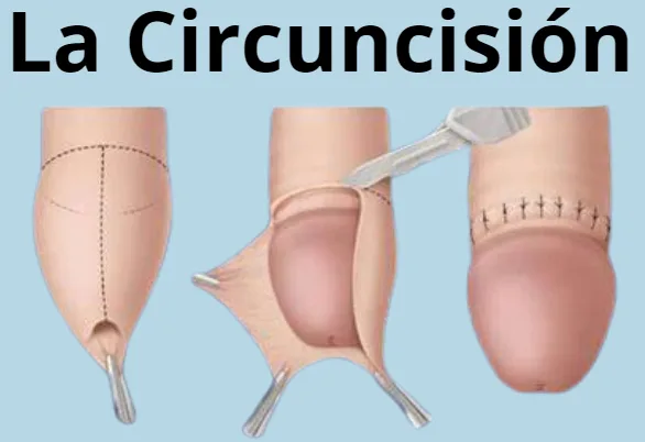 La circuncisión