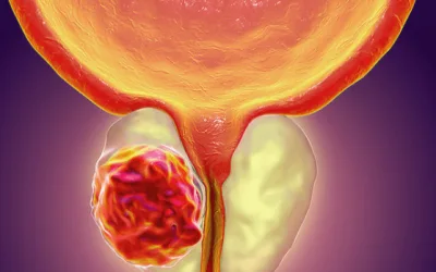 Blog 3 Cáncer de Próstata: Una enfermedad silenciosa.